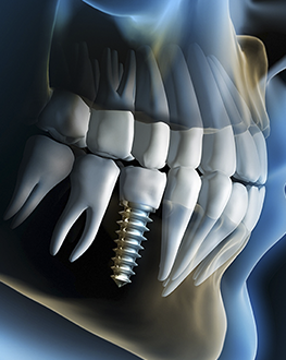 Implantes Dentários